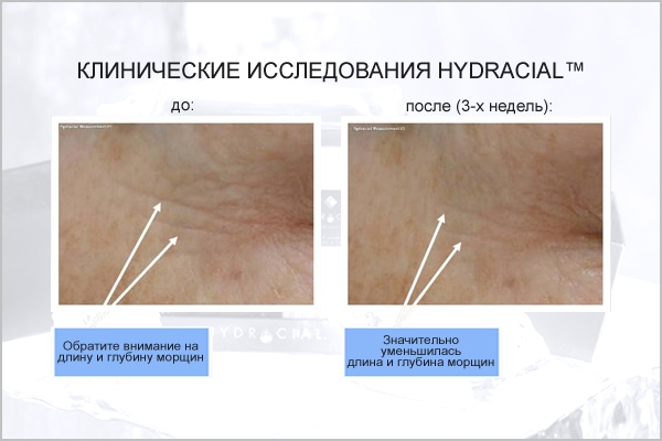 Клинические исследования анитвозрасной системы по уходу за кожей Hydracial